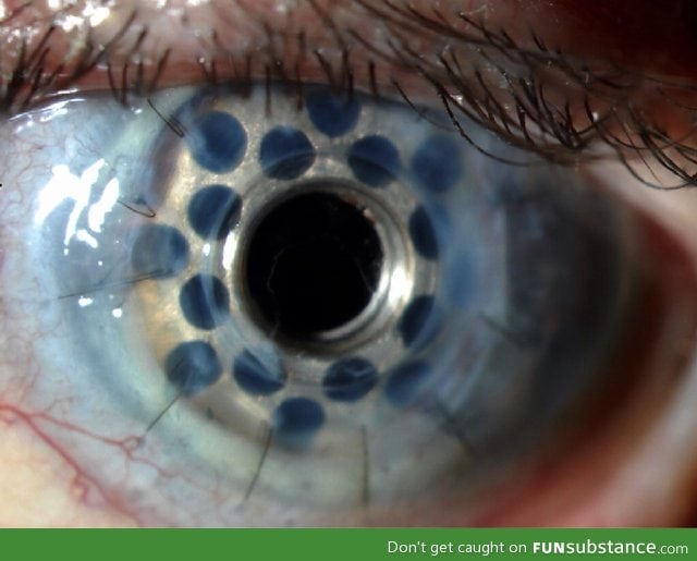 Prosthetic cornea