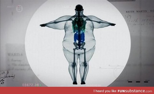 X-Ray of 800 pound man