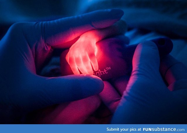 A nurse is looking for a vein on the hand of a premature baby