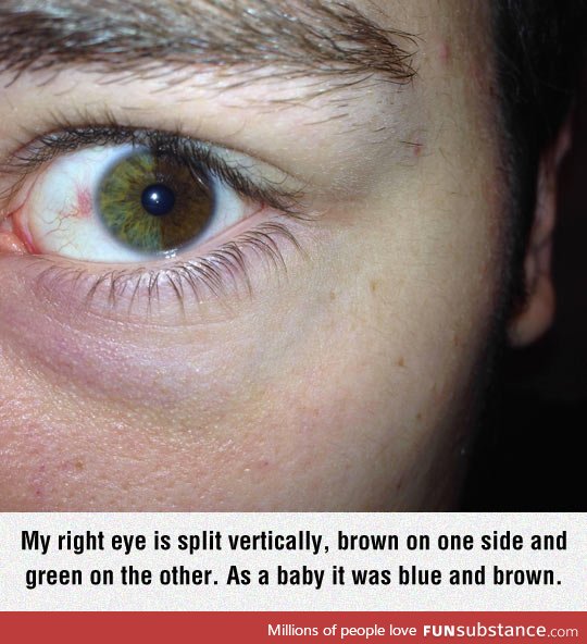 Sectoral heterochromia