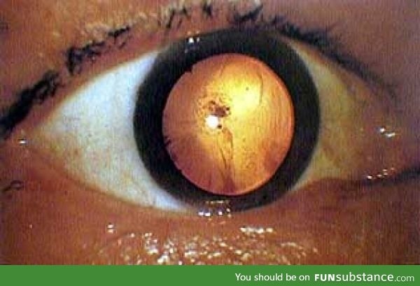 "Nuclear bomb" cataract on a Hiroshima bomb victim