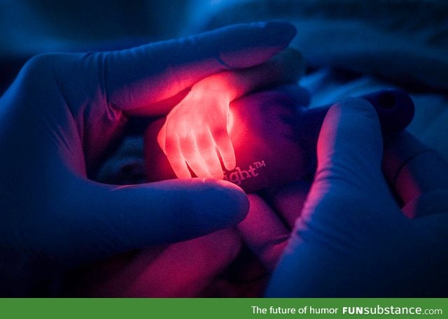 Nurse trying to find a vein in a premature baby