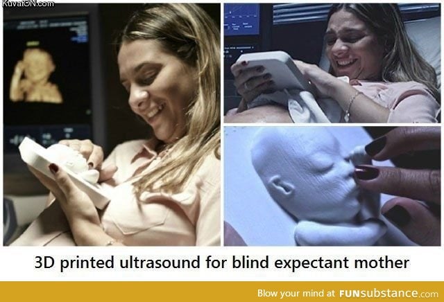 3d ultrasound