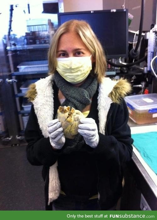 Penny, a transplant recipient, holding her Heart in her hands