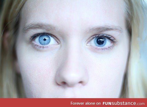 Anisocoria