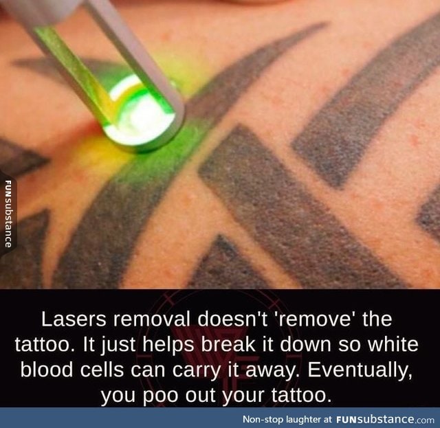 How laser tattoo removal works