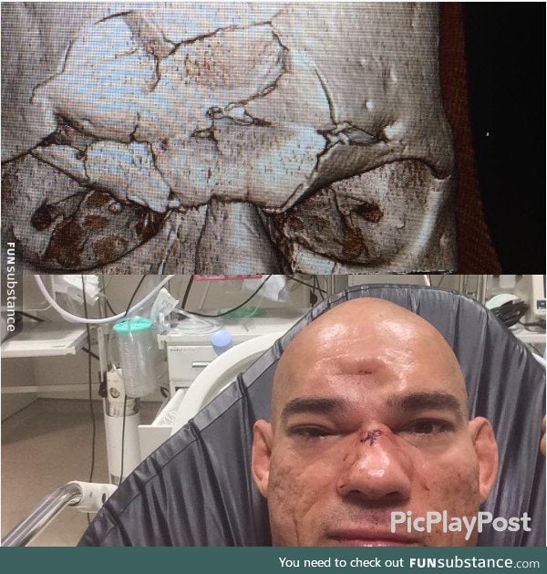 Picture of Cyborg Santos' skull - the MMA fighter that got took a knee to the head