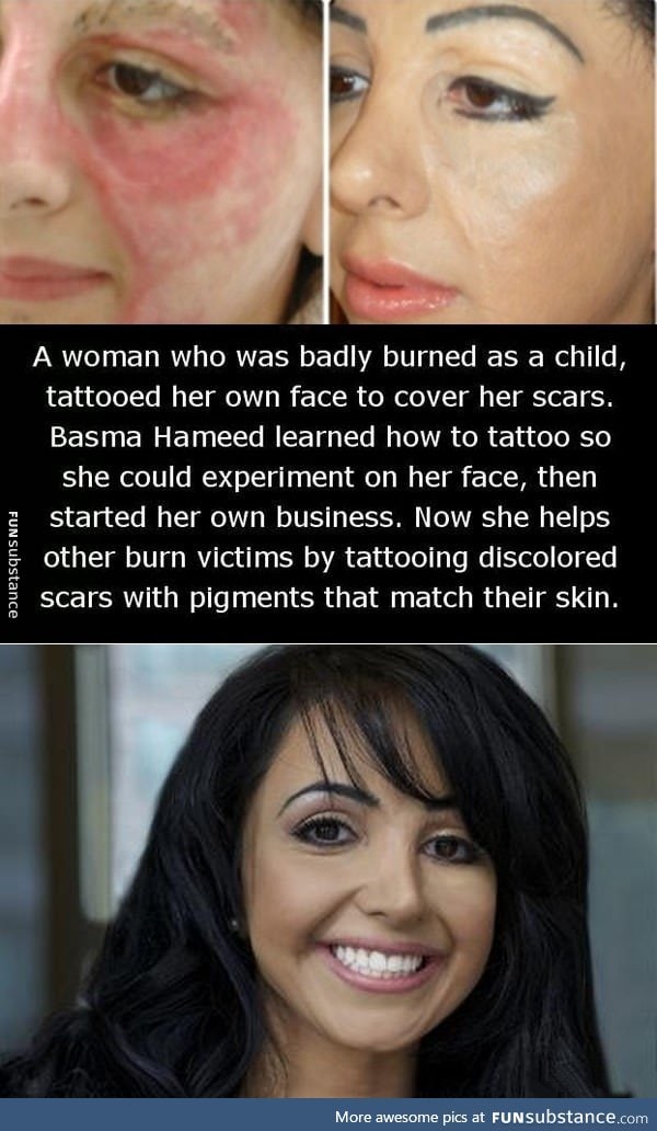 Tattooing  burn victims