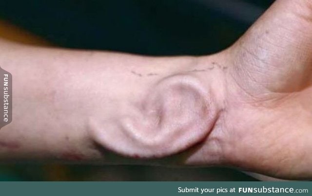 Belgian doctor grew an ear on a cancer patient's forearm