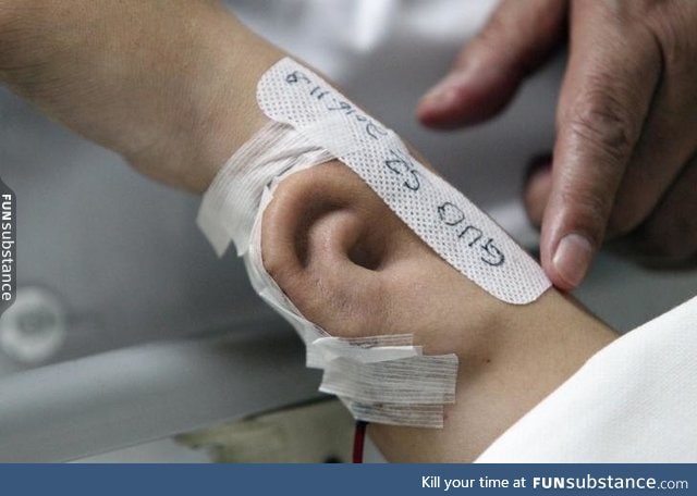 Growing an ear on the arm of a patient who lost his right ear at Xi'an Jiaotong