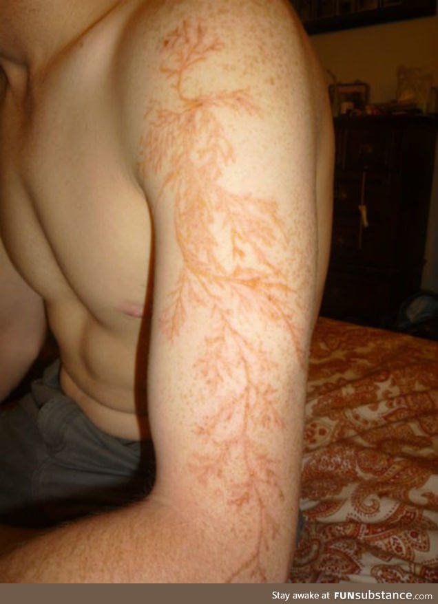 "Lichtenberg" Scar from a lightning strike