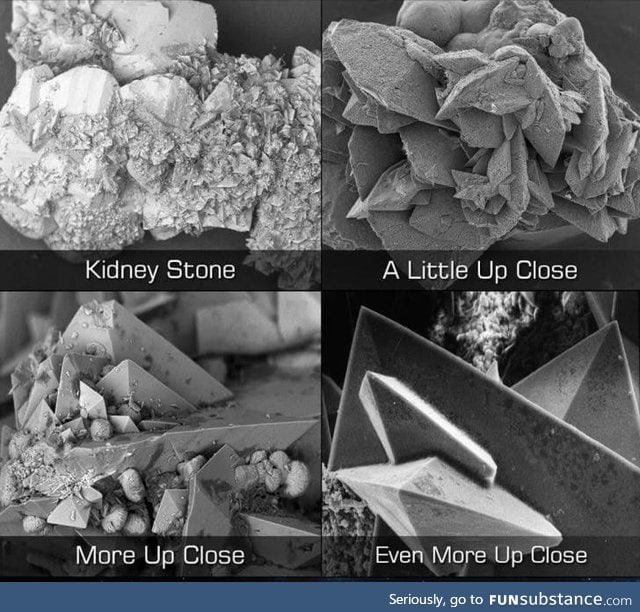 Kidney stones of death