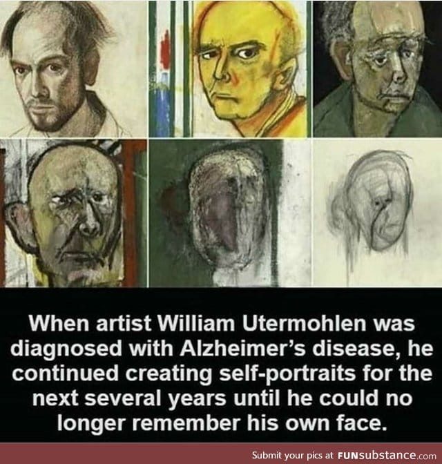 Alzheimer's disease