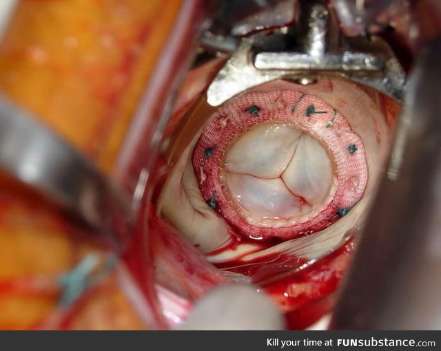 The tricuspid valve of the heart