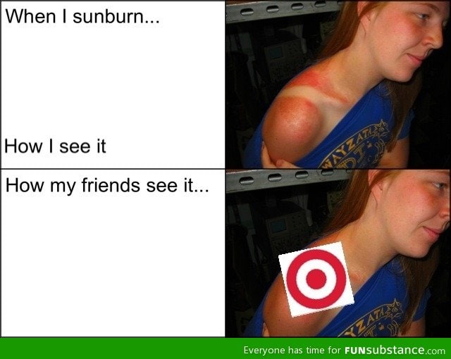 Whenever I get sunburned