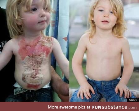 Two year old with second degree burns treated with stem cell therapy for amazing results