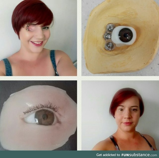 Prosthetic eye