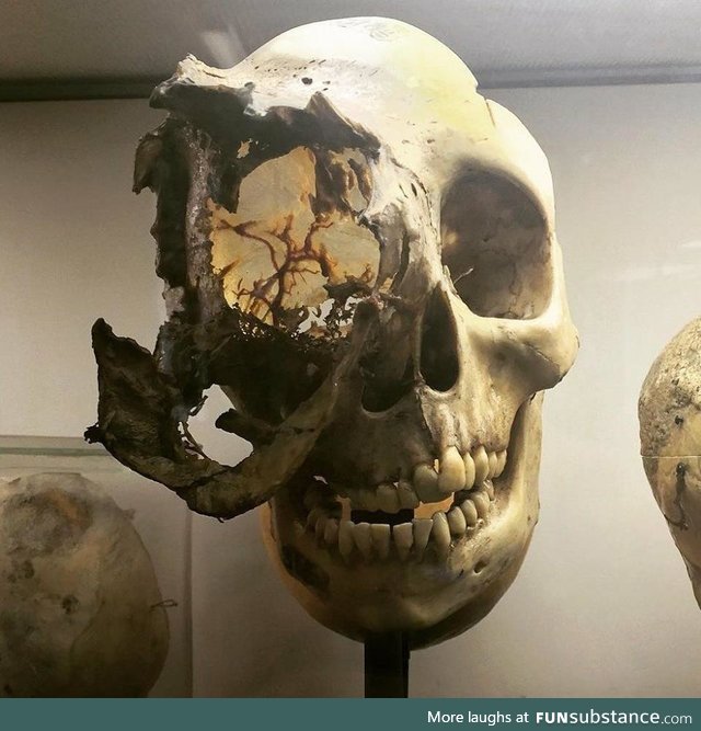 A skull with rare bone cancer (Chordoma)