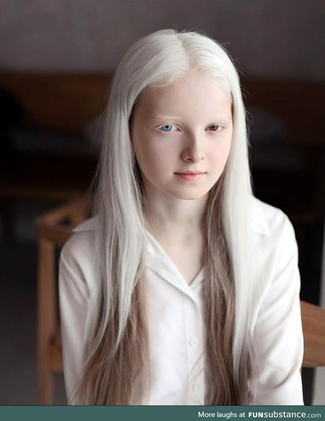 Girl with Albinism and Heterochromia