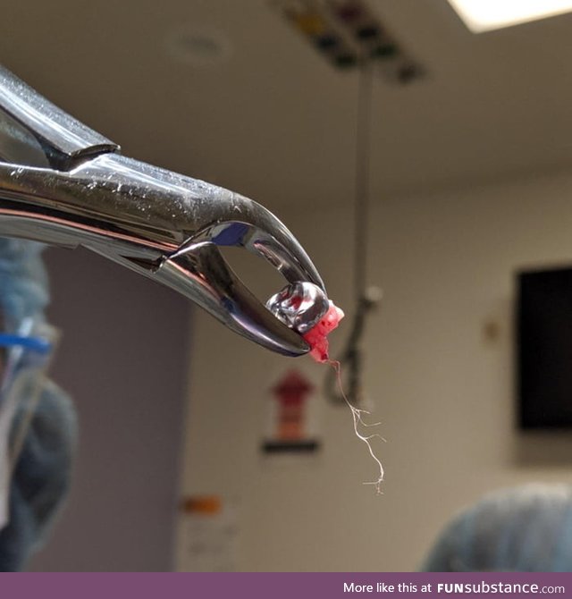 Extracted tooth with intact nerve root - super rare