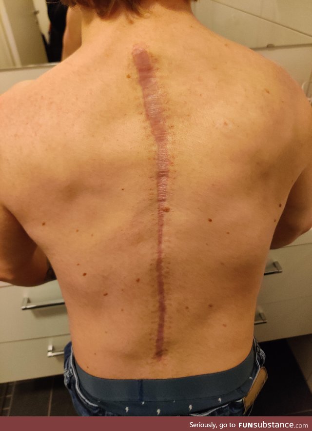 Me after four months of recovery from scoliosis surgery (I had 70°)