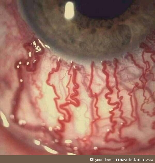 Human eye after crying