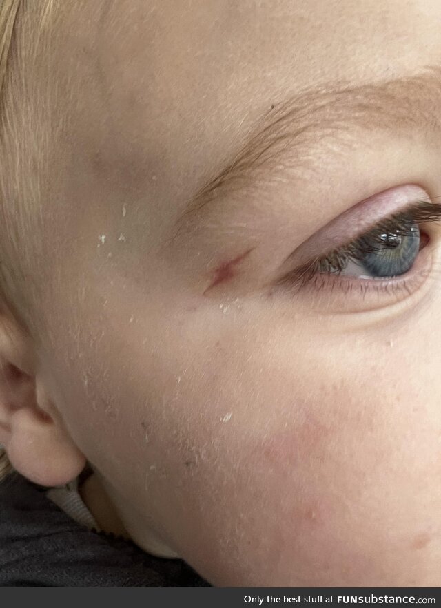 My sons lightning bolt scar