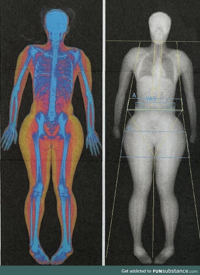 Body Composition of bone, muscle, and fat