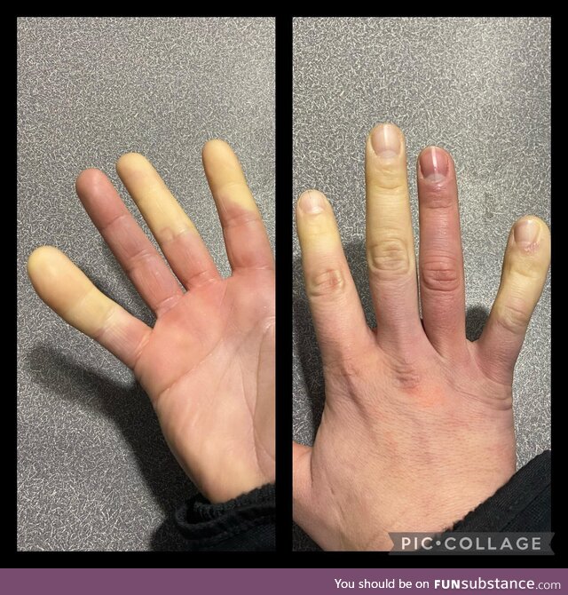 Winter = Raynaud’s Syndrome