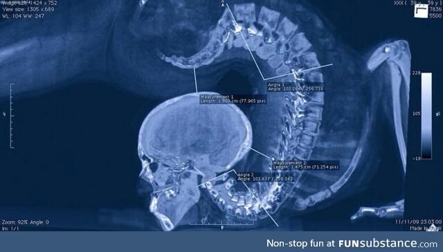 X-ray of a contortionist