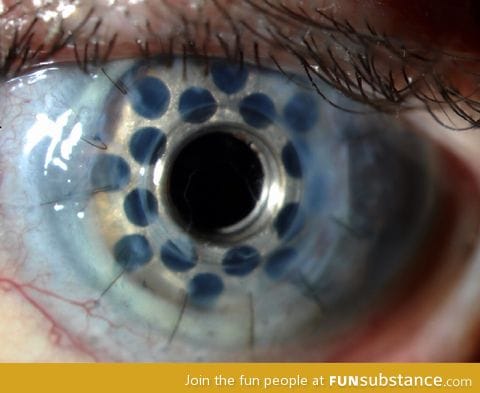 Prosthetic cornea