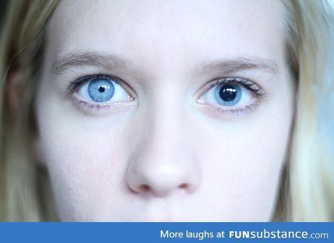 Anisocoria