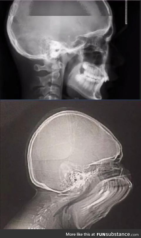 What happens if you sneeze while taking X-ray