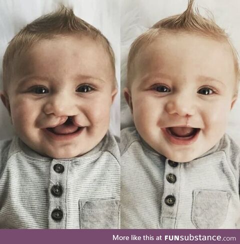 Cleft lip and cleft palate, two week surgery!