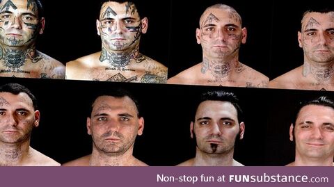 Reformed skinhead endures 25 surgeries over the course of 16 months to remove tattoos