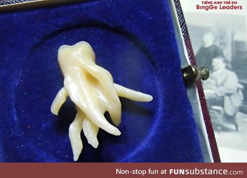 This wisdom tooth's root